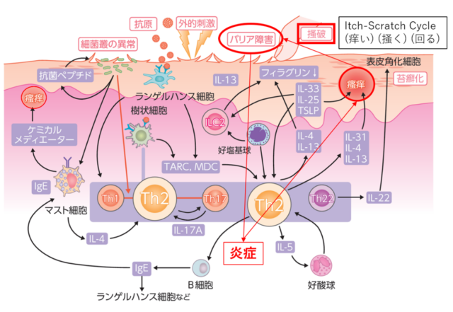 アトピー性皮膚炎の原因・病態
